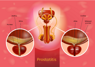 prostatit