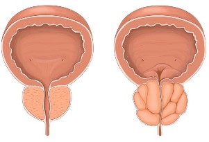 Prostatit