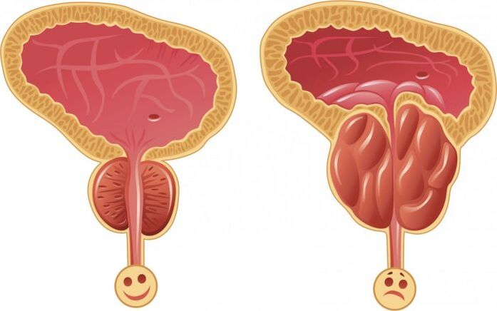 prostatit ile sağlıklı ve iltihaplı prostat