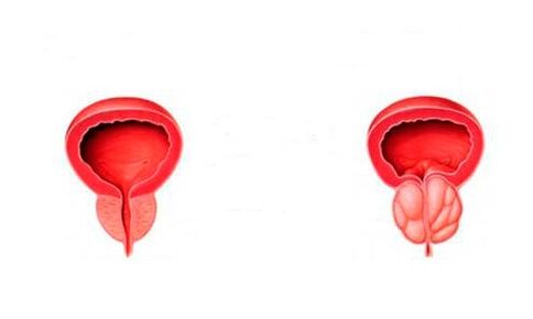 prostatit ile sağlıklı ve iltihaplı prostat