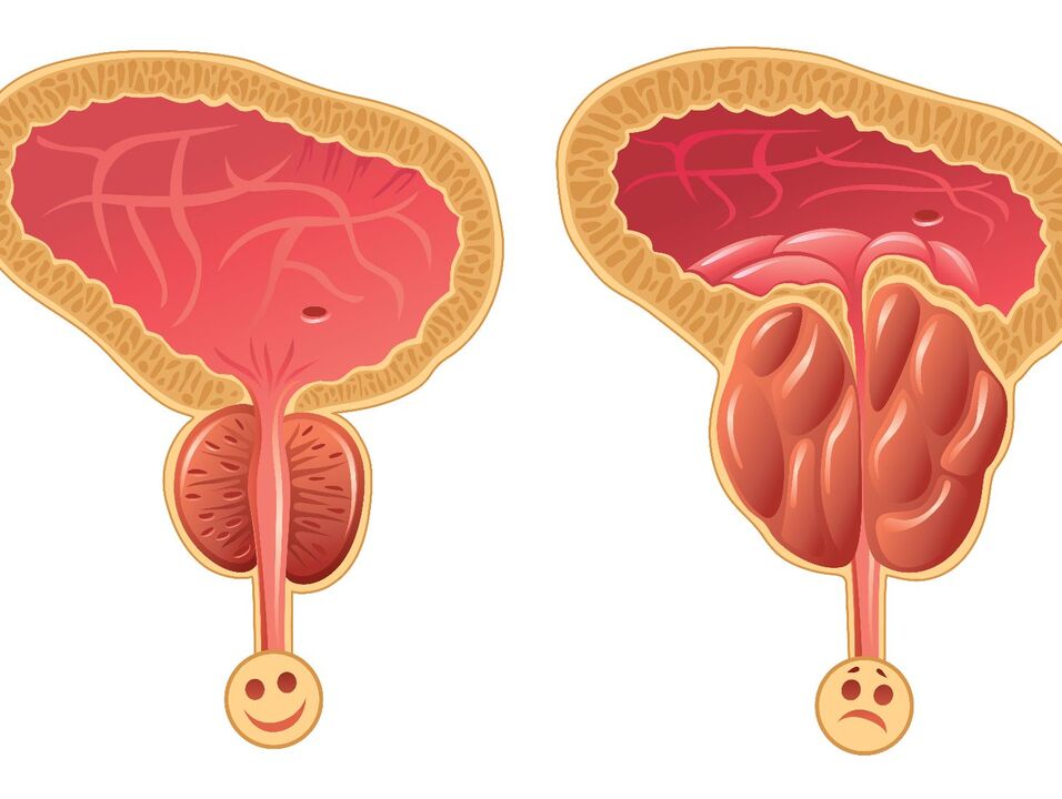 Sağlıklı prostat bezi ve konjestif prostatit ile prostat tıkanıklığı